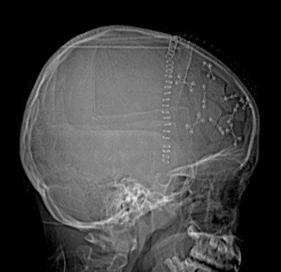 Skull fracture x-ray from baseball line drive